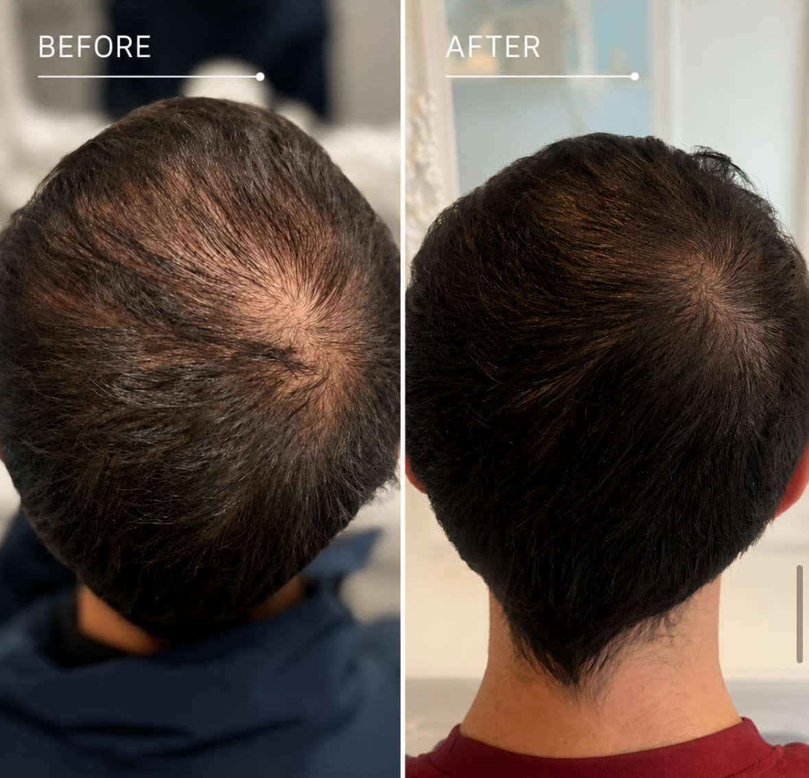 Before and after LLLT Laser Hair Therapy for Male thinning hair and hair loss.