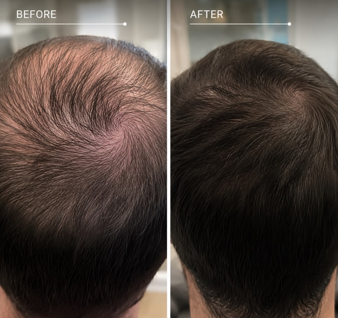 Before and after LLLT Laser Hair Therapy for male thinning hair and hair loss.