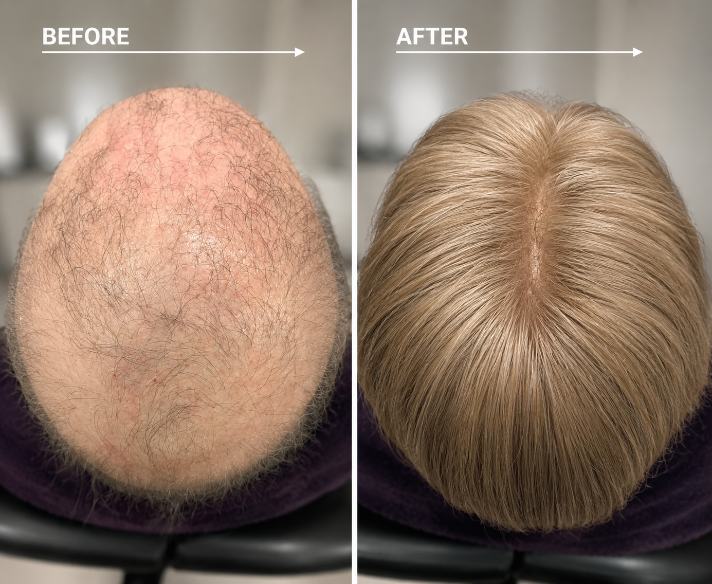 Before and after Hair Replacement System for female thinning hair and hair loss.
