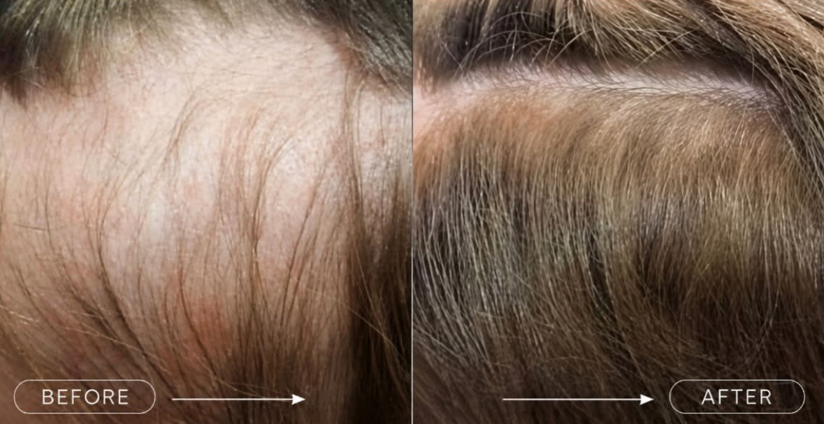 Before and after LLLT Laser Hair Therapy for female thinning hair and hair loss.