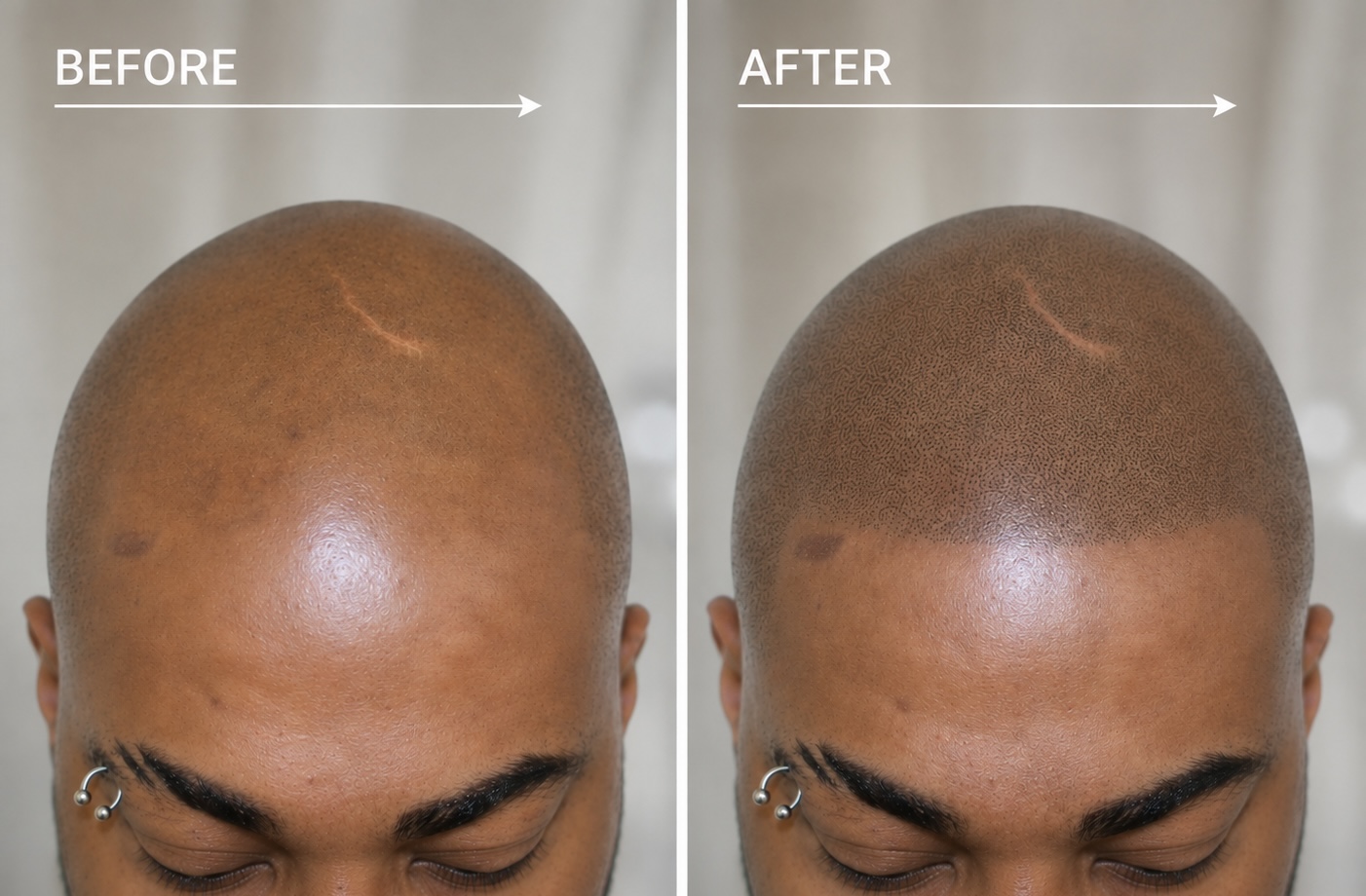 Before and after Scalp Micropigmentation for male thinning hair and hair loss.