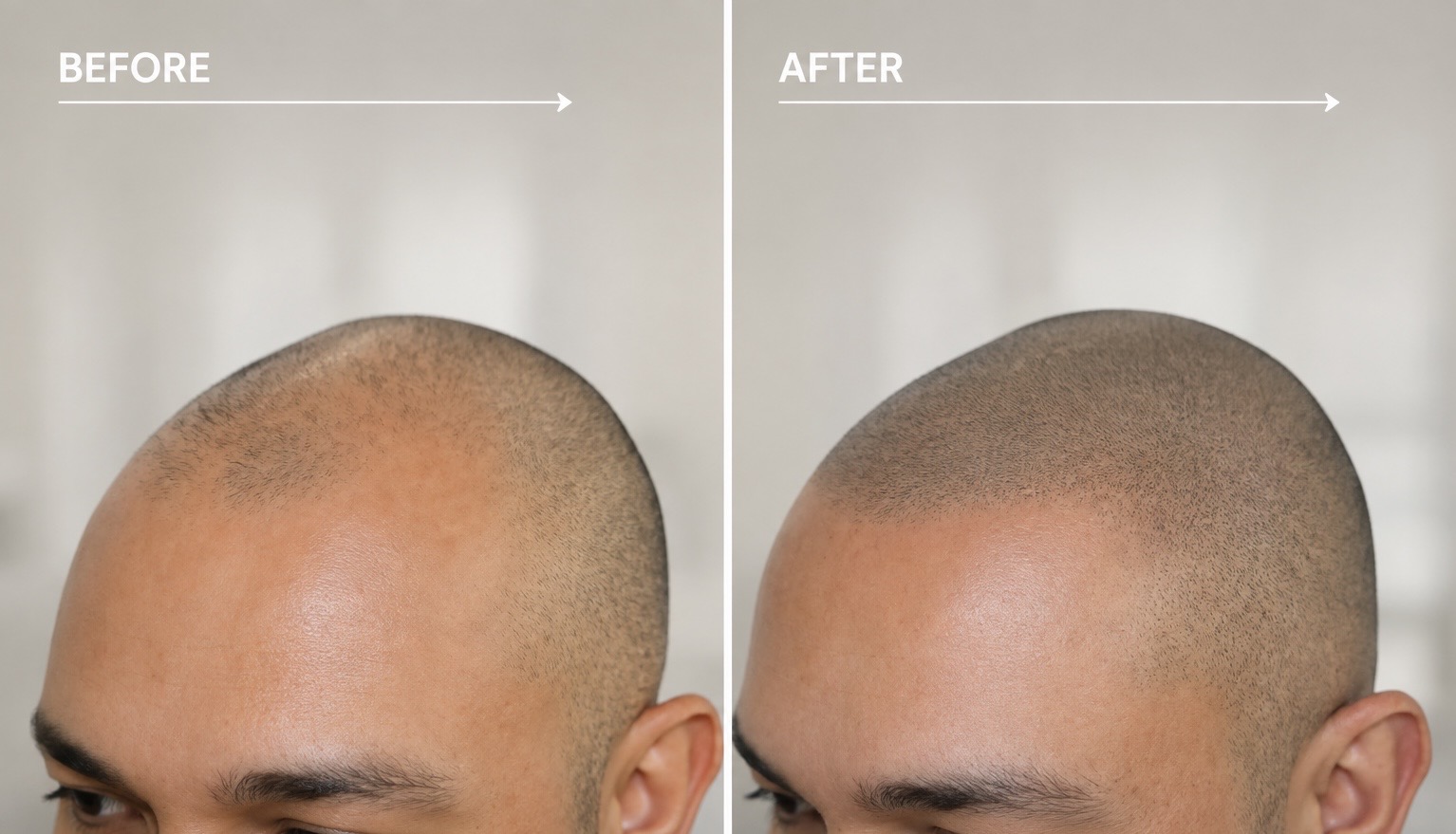 Before and after Scalp Micropigmentation for male thinning hair and hair loss.