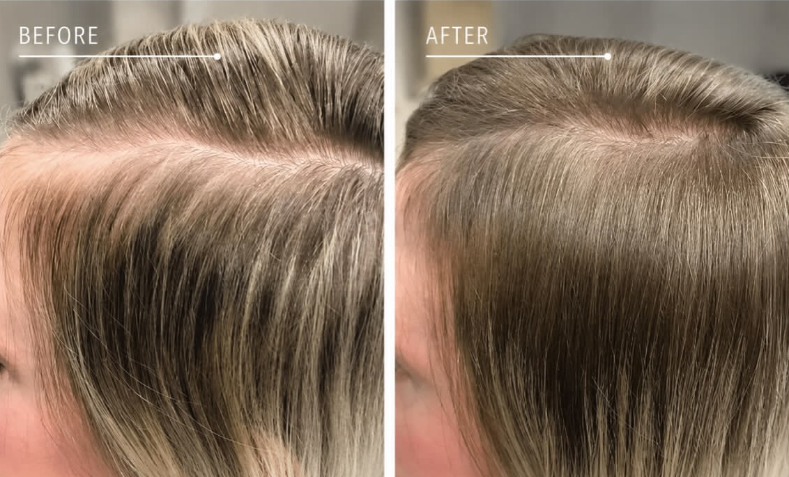 Before and after LLLT Laser Hair Therapy for female thinning hair and hair loss.