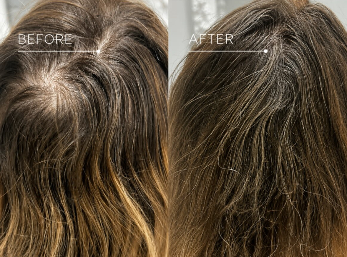 Before and after LLLT Laser Hair Therapy for female thinning hair and hair loss.