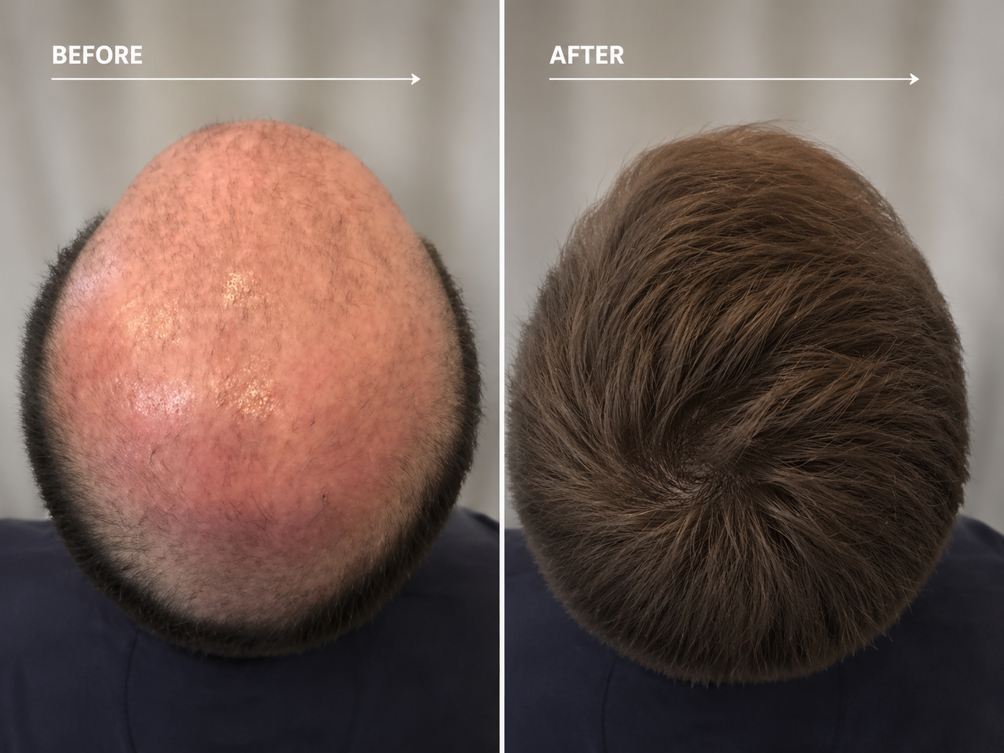 Before and after Hair Replacement System for male thinning hair and hair loss.